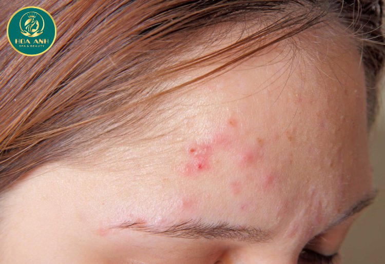 10 phương pháp điều trị mụn trứng cá ở tuổi teen P1